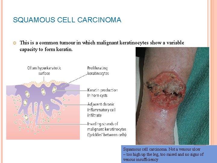 SQUAMOUS CELL CARCINOMA This is a common tumour in which malignant keratinocytes show a