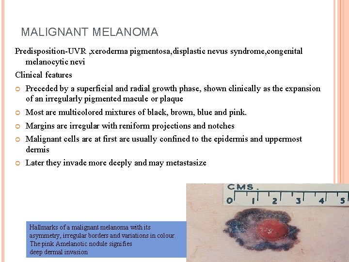 MALIGNANT MELANOMA Predisposition-UVR , xeroderma pigmentosa, displastic nevus syndrome, congenital melanocytic nevi Clinical features