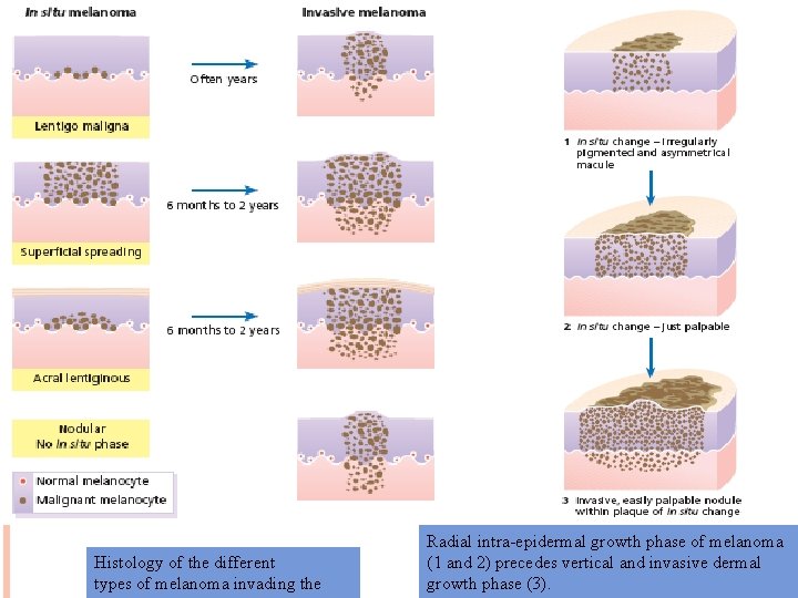 Histology of the different types of melanoma invading the Radial intra-epidermal growth phase of