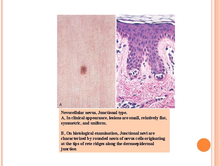 Nevocellular nevus, Junctional type. A, In clinical appearance, lesions are small, relatively flat, symmetric,