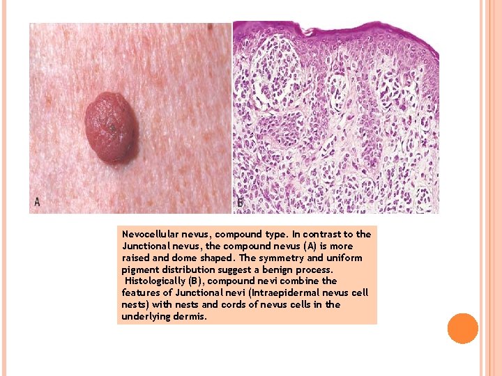 Nevocellular nevus, compound type. In contrast to the Junctional nevus, the compound nevus (A)