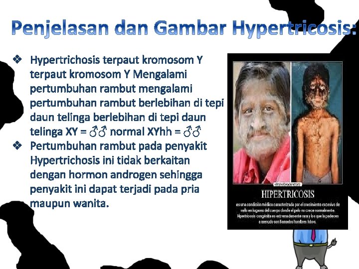 v Hypertrichosis terpaut kromosom Y Mengalami pertumbuhan rambut mengalami pertumbuhan rambut berlebihan di tepi