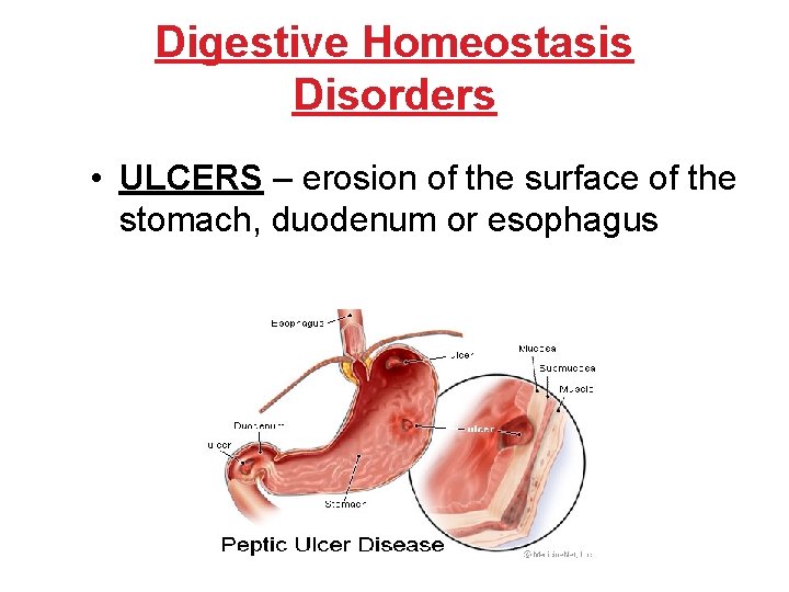 Digestive Homeostasis Disorders • ULCERS – erosion of the surface of the stomach, duodenum Digestive Homeostasis Disorders • ULCERS – erosion of the surface of the stomach, duodenum