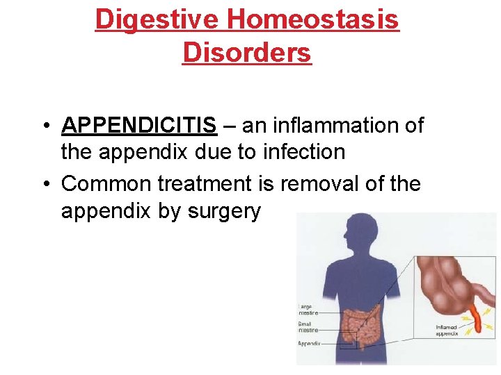 Digestive Homeostasis Disorders • APPENDICITIS – an inflammation of the appendix due to infection Digestive Homeostasis Disorders • APPENDICITIS – an inflammation of the appendix due to infection