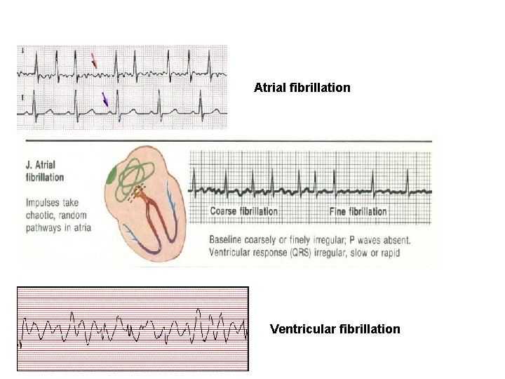 Atrial fibrillation Ventricular fibrillation 