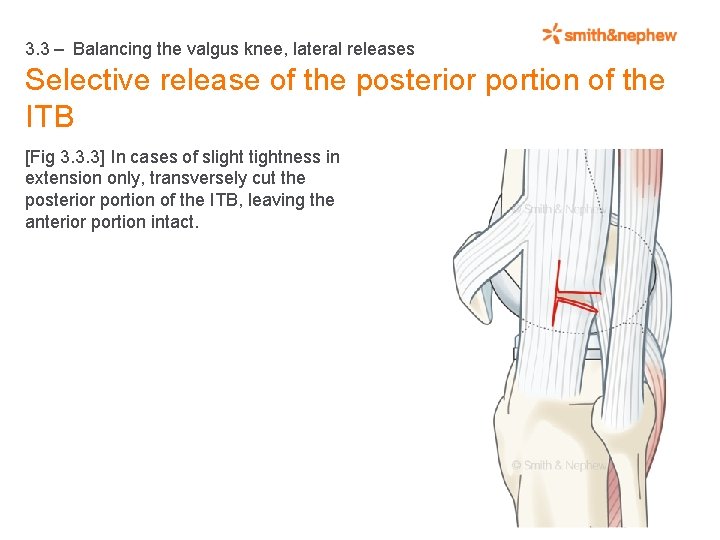 3. 3 – Balancing the valgus knee, lateral releases Selective release of the posterior
