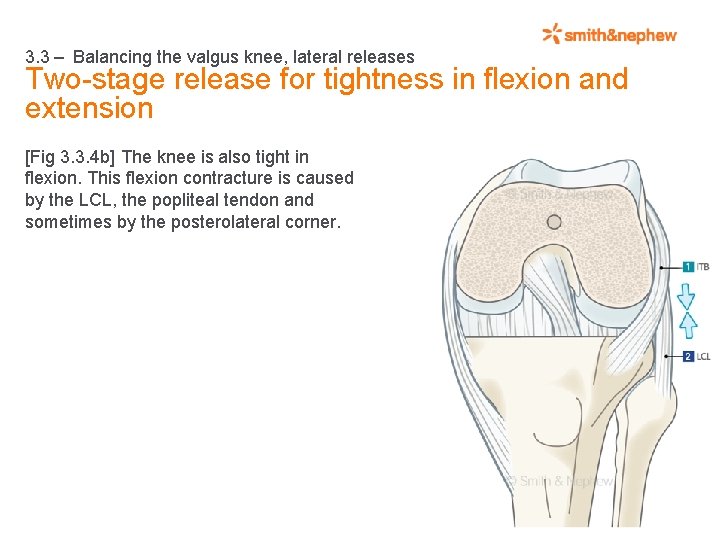 3. 3 – Balancing the valgus knee, lateral releases Two-stage release for tightness in