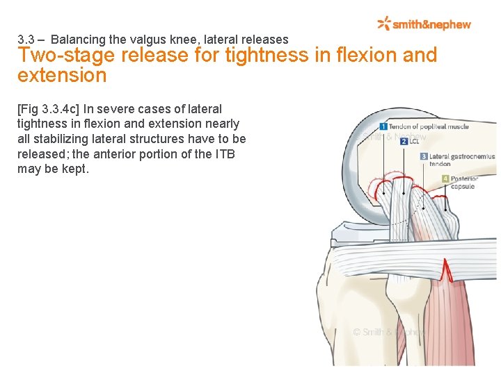 3. 3 – Balancing the valgus knee, lateral releases Two-stage release for tightness in