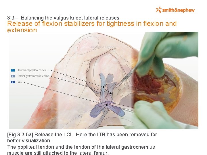3. 3 – Balancing the valgus knee, lateral releases Release of flexion stabilizers for