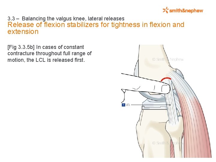 3. 3 – Balancing the valgus knee, lateral releases Release of flexion stabilizers for