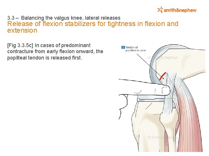 3. 3 – Balancing the valgus knee, lateral releases Release of flexion stabilizers for