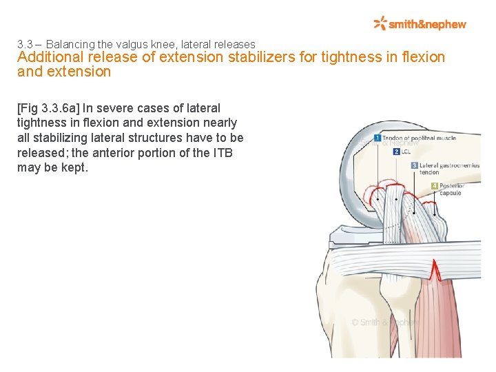 3. 3 – Balancing the valgus knee, lateral releases Additional release of extension stabilizers