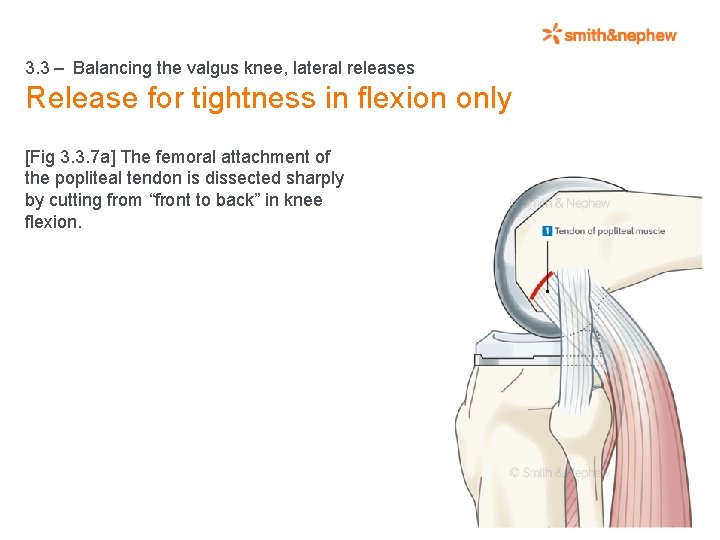 3. 3 – Balancing the valgus knee, lateral releases Release for tightness in flexion