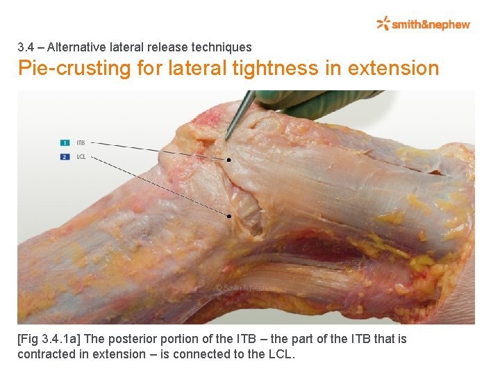 3. 4 – Alternative lateral release techniques Pie-crusting for lateral tightness in extension [Fig