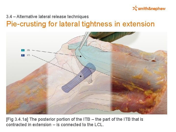 3. 4 – Alternative lateral release techniques Pie-crusting for lateral tightness in extension [Fig