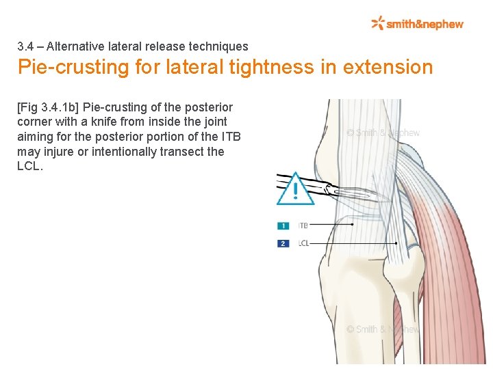 3. 4 – Alternative lateral release techniques Pie-crusting for lateral tightness in extension [Fig