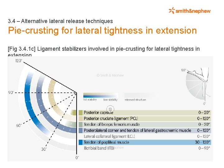 3. 4 – Alternative lateral release techniques Pie-crusting for lateral tightness in extension [Fig