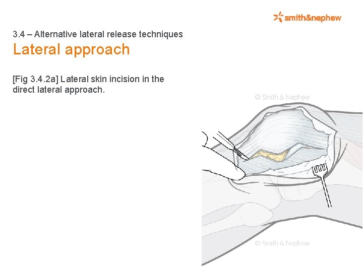 3. 4 – Alternative lateral release techniques Lateral approach [Fig 3. 4. 2 a]