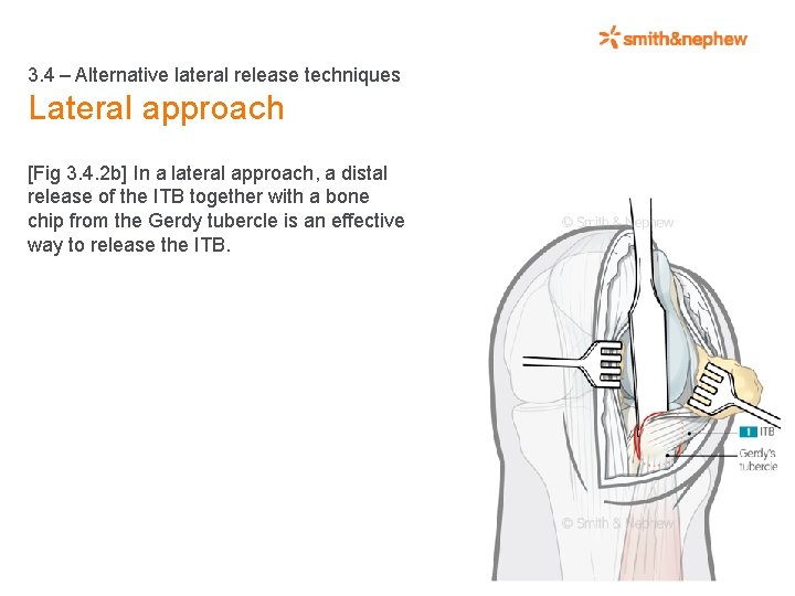 3. 4 – Alternative lateral release techniques Lateral approach [Fig 3. 4. 2 b]