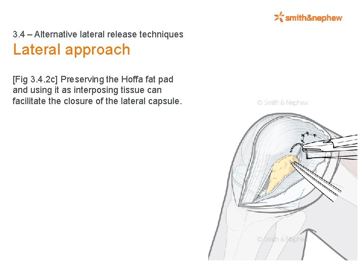 3. 4 – Alternative lateral release techniques Lateral approach [Fig 3. 4. 2 c]