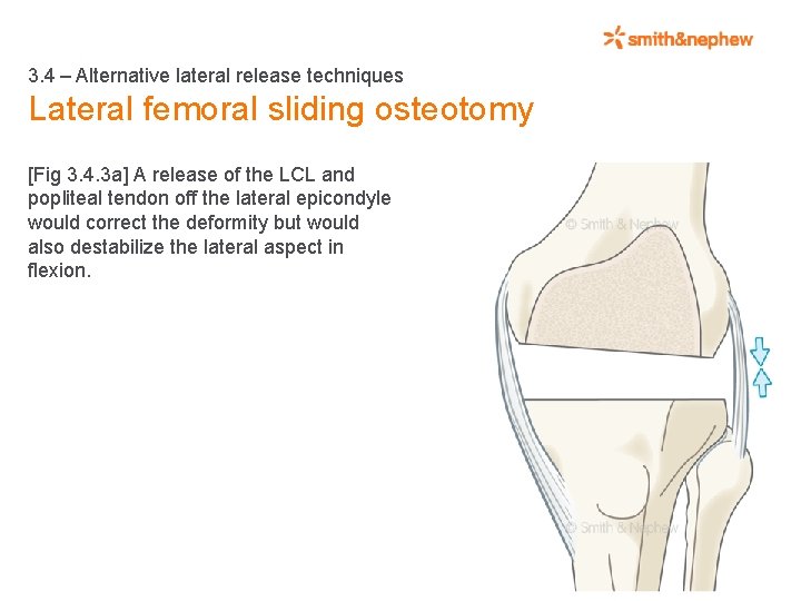 3. 4 – Alternative lateral release techniques Lateral femoral sliding osteotomy [Fig 3. 4.
