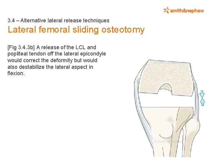 3. 4 – Alternative lateral release techniques Lateral femoral sliding osteotomy [Fig 3. 4.