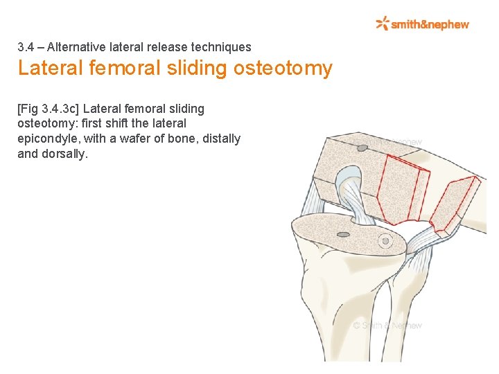 3. 4 – Alternative lateral release techniques Lateral femoral sliding osteotomy [Fig 3. 4.