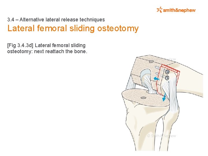 3. 4 – Alternative lateral release techniques Lateral femoral sliding osteotomy [Fig 3. 4.