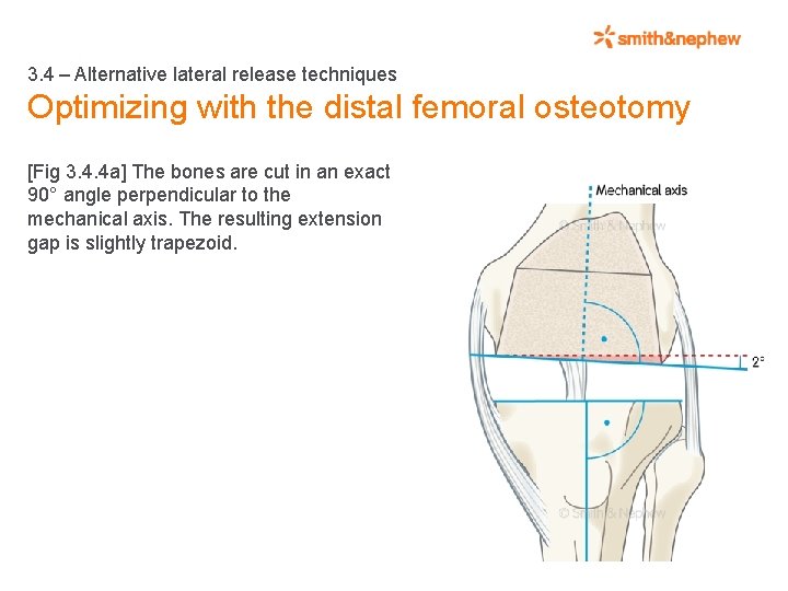 3. 4 – Alternative lateral release techniques Optimizing with the distal femoral osteotomy [Fig