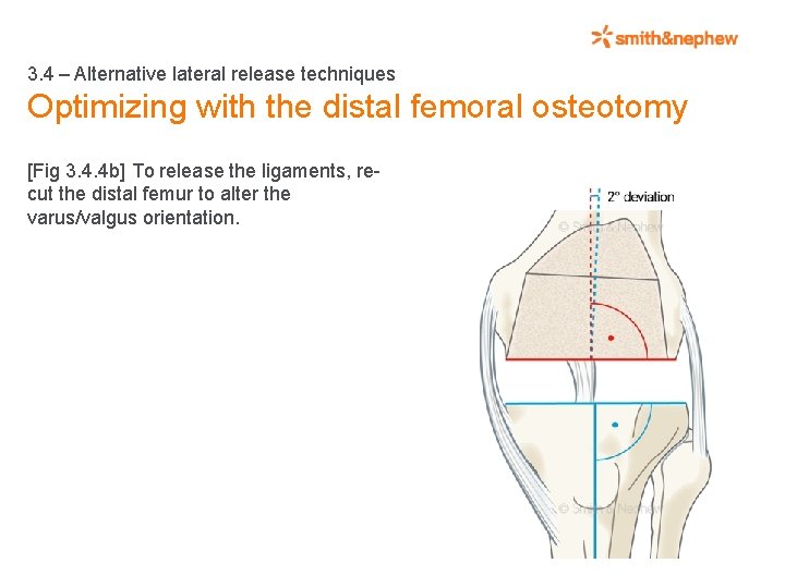 3. 4 – Alternative lateral release techniques Optimizing with the distal femoral osteotomy [Fig