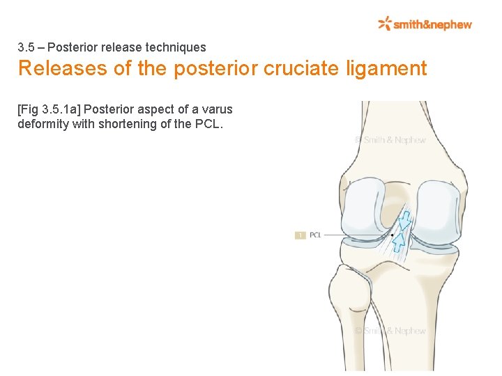 3. 5 – Posterior release techniques Releases of the posterior cruciate ligament [Fig 3.
