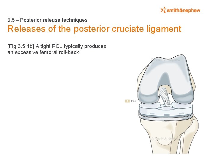 3. 5 – Posterior release techniques Releases of the posterior cruciate ligament [Fig 3.