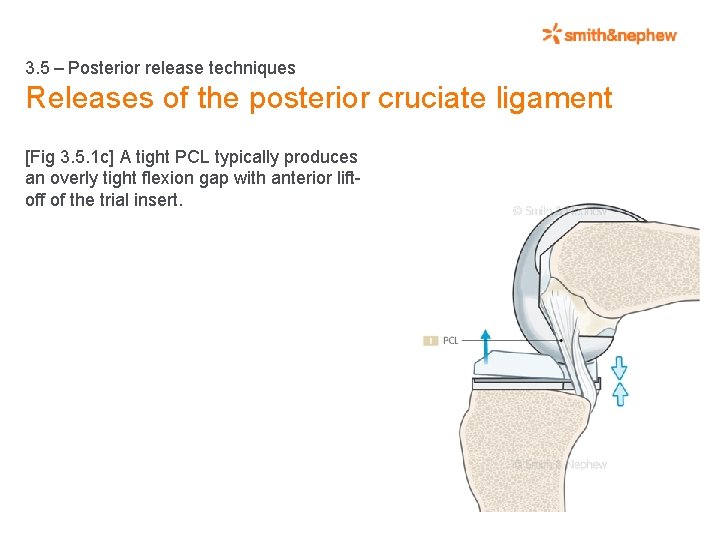 3. 5 – Posterior release techniques Releases of the posterior cruciate ligament [Fig 3.