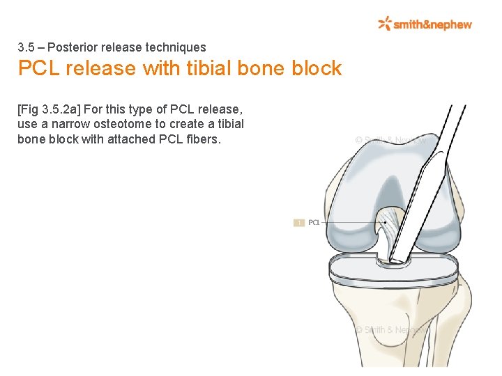 3. 5 – Posterior release techniques PCL release with tibial bone block [Fig 3.