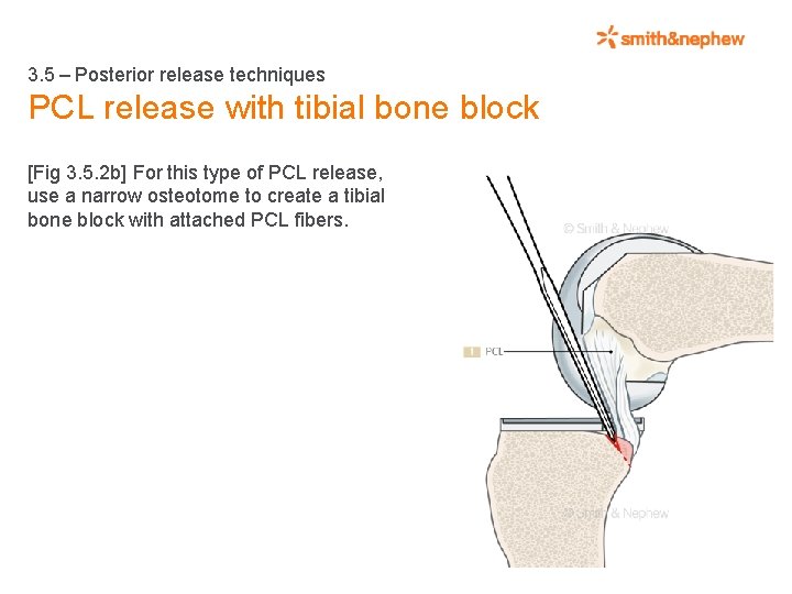 3. 5 – Posterior release techniques PCL release with tibial bone block [Fig 3.