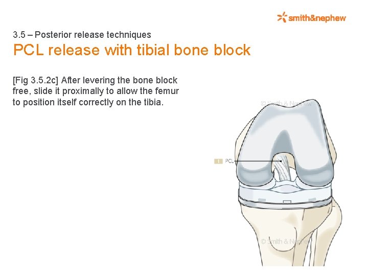 3. 5 – Posterior release techniques PCL release with tibial bone block [Fig 3.