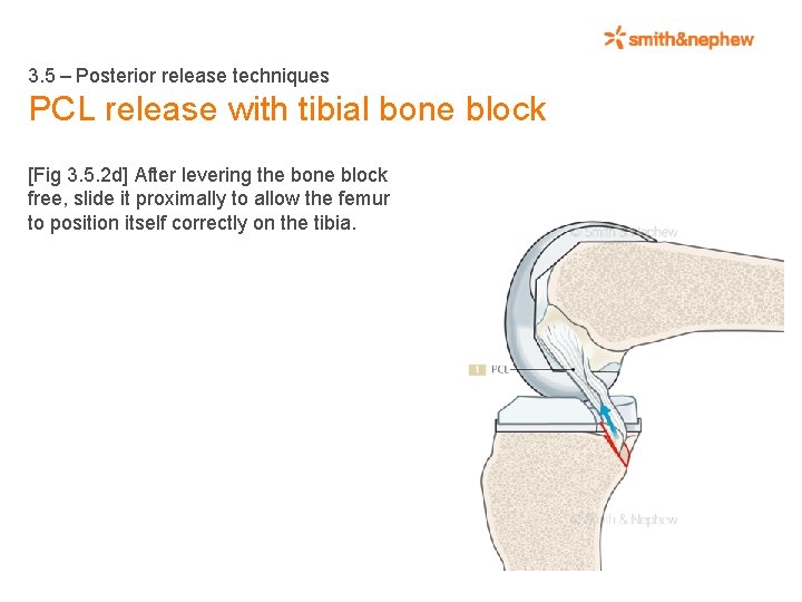 3. 5 – Posterior release techniques PCL release with tibial bone block [Fig 3.