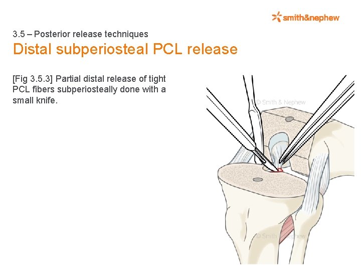 3. 5 – Posterior release techniques Distal subperiosteal PCL release [Fig 3. 5. 3]