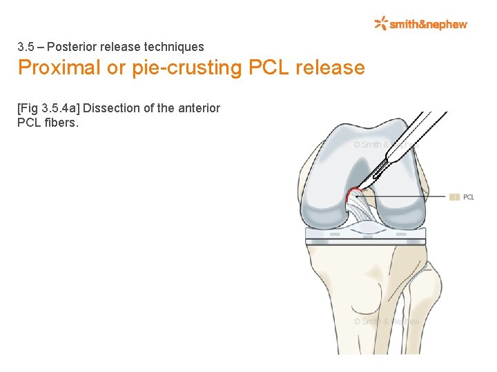 3. 5 – Posterior release techniques Proximal or pie-crusting PCL release [Fig 3. 5.