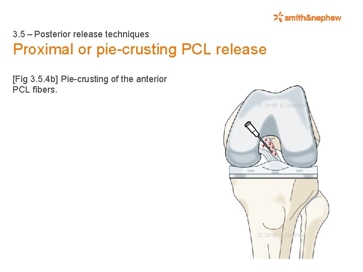 3. 5 – Posterior release techniques Proximal or pie-crusting PCL release [Fig 3. 5.