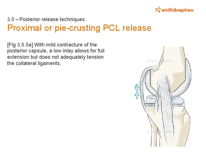 3. 5 – Posterior release techniques Proximal or pie-crusting PCL release [Fig 3. 5.