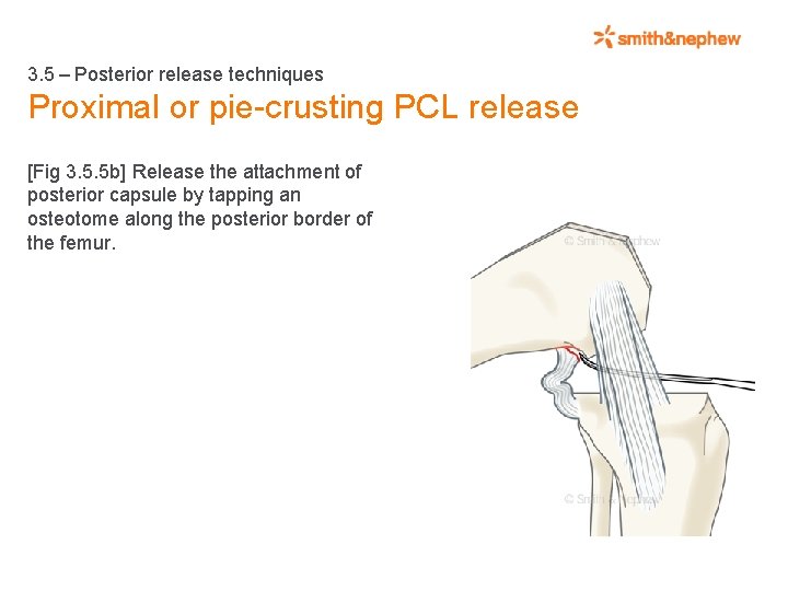 3. 5 – Posterior release techniques Proximal or pie-crusting PCL release [Fig 3. 5.