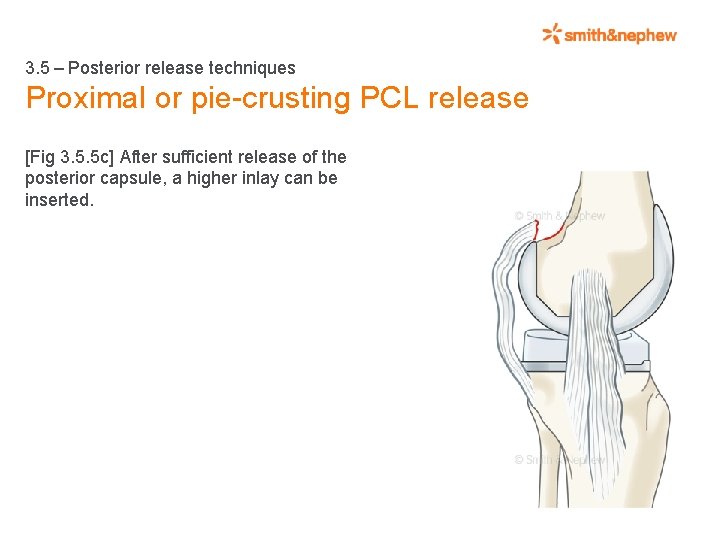 3. 5 – Posterior release techniques Proximal or pie-crusting PCL release [Fig 3. 5.