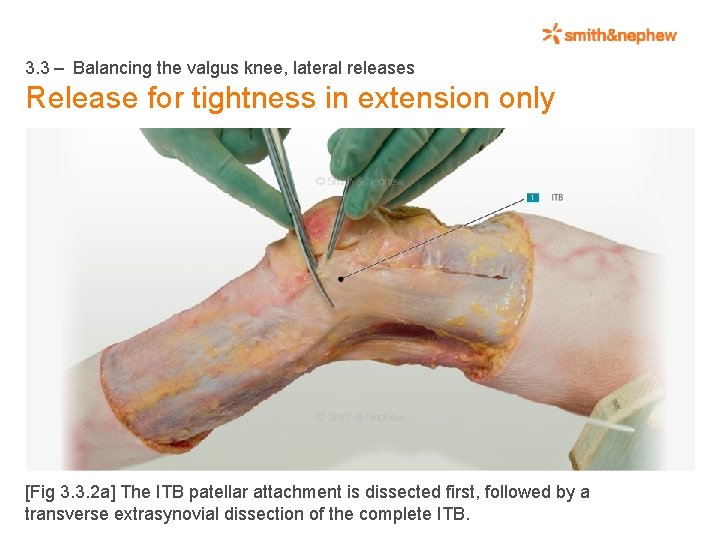 3. 3 – Balancing the valgus knee, lateral releases Release for tightness in extension