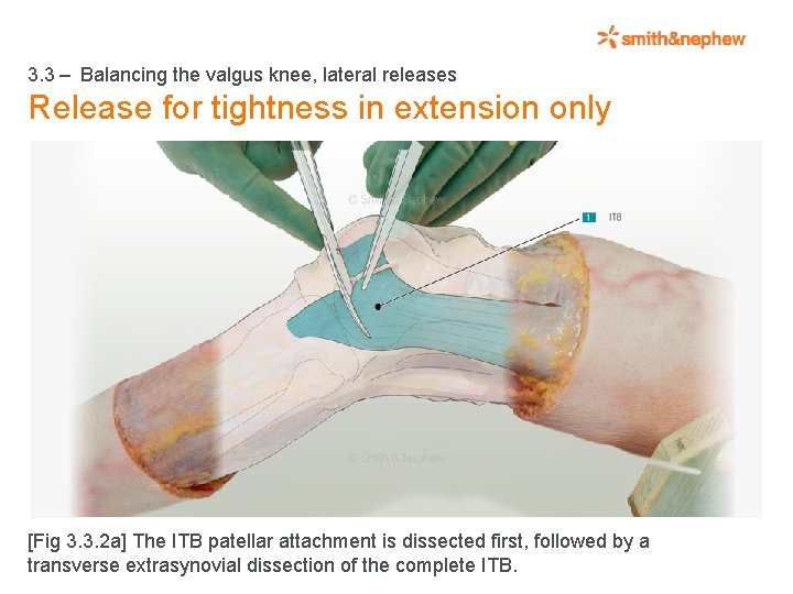 3. 3 – Balancing the valgus knee, lateral releases Release for tightness in extension