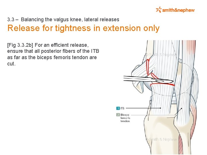 3. 3 – Balancing the valgus knee, lateral releases Release for tightness in extension