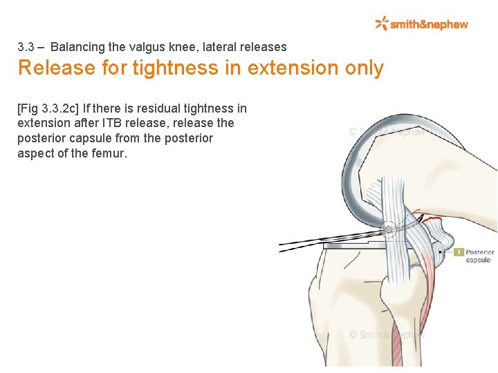 3. 3 – Balancing the valgus knee, lateral releases Release for tightness in extension
