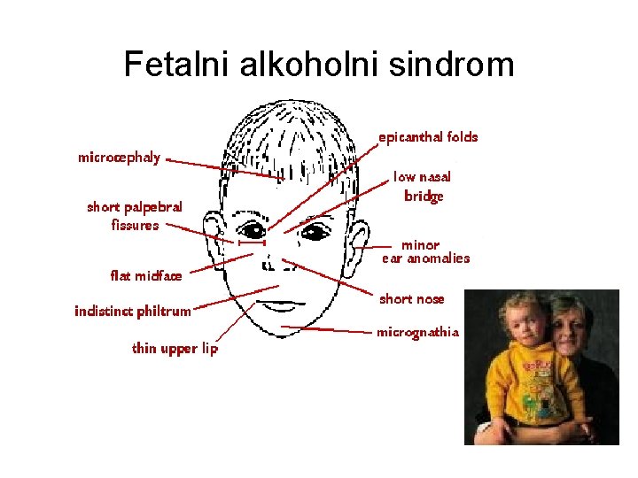 Fetalni alkoholni sindrom Fetalni alkoholni sindrom