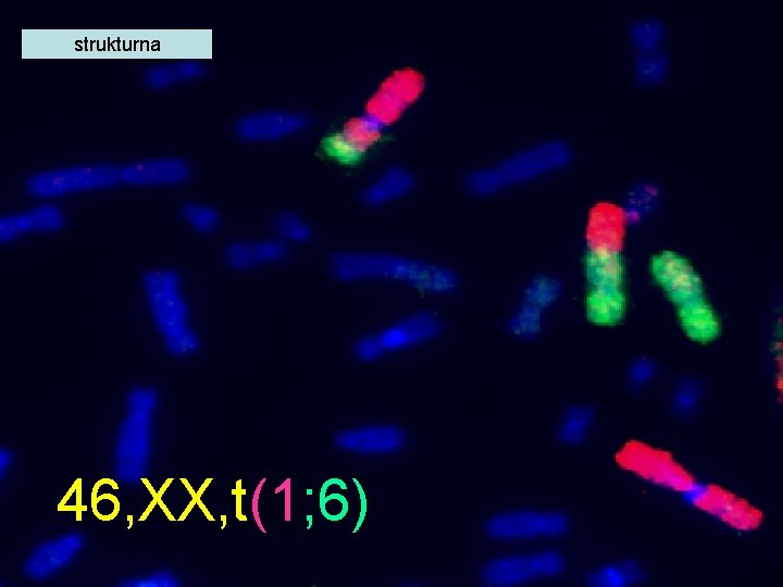 strukturna 46, XX, t(1; 6) 