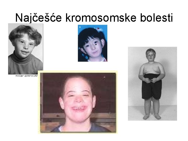 Najčešće kromosomske bolesti Najčešće kromosomske bolesti
